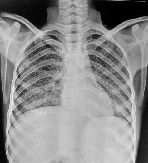 Miliary tuberculosis radiology reference article radiopaedia org – Artofit