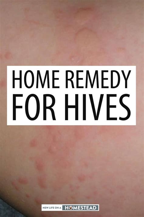 Natural Home Remedy For Hives • New Life On A Homestead