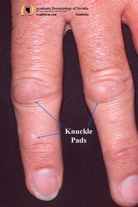 Knuckle Pads: Heloderma... - Academic Dermatology of Nevada