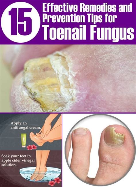 15 Natural Remedies & Prevention Tips for Toenail Fungus | Toenail fungus, Fungi, Remedies