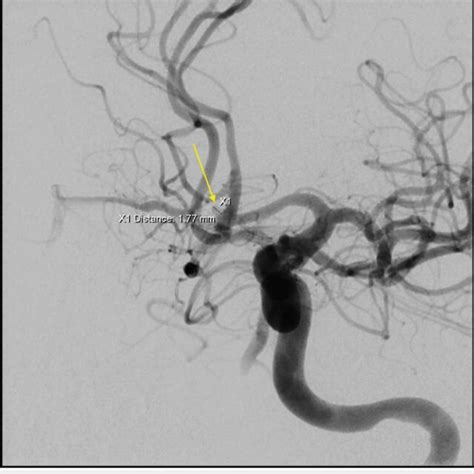 Angiogram of left internal carotid artery revealing an aneurysm... | Download Scientific Diagram