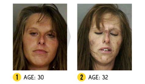 Before and after pics of crystal meth users are enough to put you off for life | Metro News