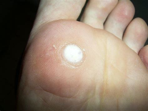 File:Plantar wart after treatment with salicylic acid.jpg - Wikipedia