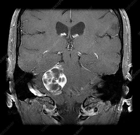 Large Vestibular Schwannoma MRI - Stock Image - C043/3194 - Science Photo Library