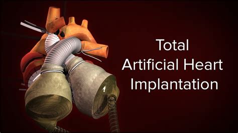 Medical Animation: Total Artificial Heart Implantation | Cincinnati Children's - YouTube