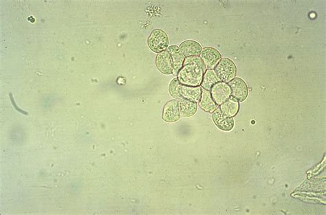 Renal Tubular Epithelial Cells Urine | Hot Sex Picture