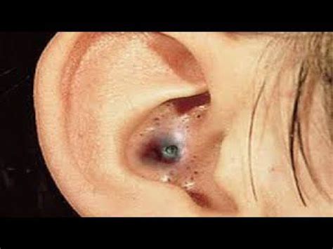 Pin on pimples, pus, tonsil stones, gross and weird