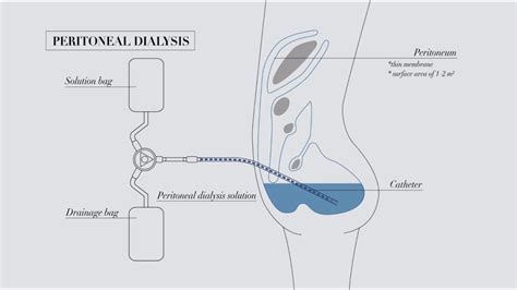 Understanding peritoneal dialysis - YouTube