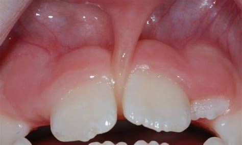 Labial Frenectomy