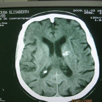 Axial brain ct showing pineal gland calcification | Download Scientific Diagram