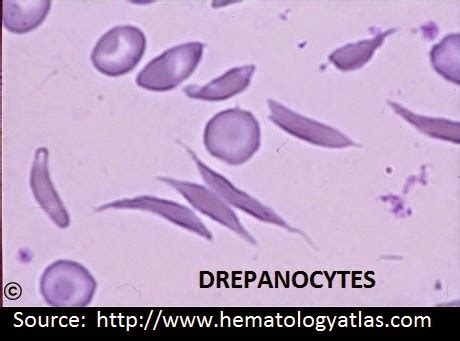 Lab Atlas: Drepanocytes