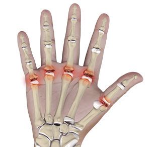 Metacarpophalangeal Joint Arthritis Seattle | Arthroplasty ...