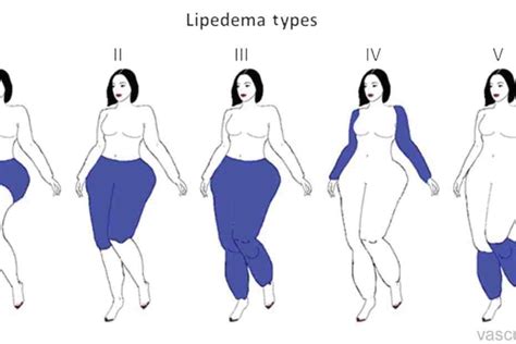 Lipedema: áreas de distribuição. - Vascular.pro