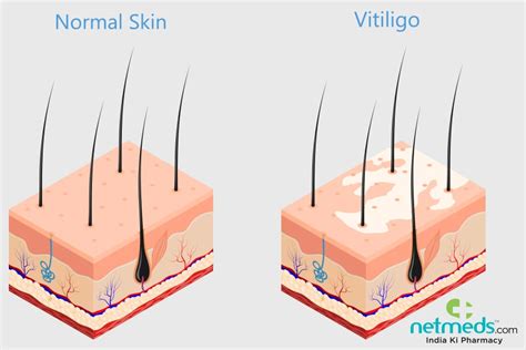 Vitiligo: Causes, Symptoms and Treatment