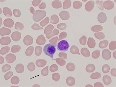 teardrop cells myelofibrosis