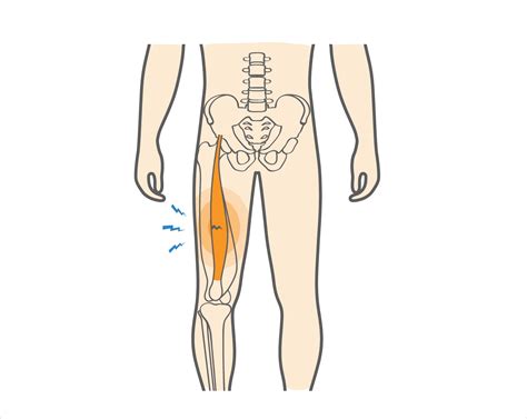 What is a Quadriceps Strain & How to Recover from This Injury? - Upswing Health