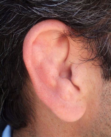 Cauliflower Ear Surgery. - Page 4 - Sherdog Mixed Martial Arts Forums