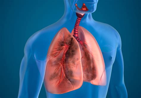 Lung Disease – Pulmonary Practice