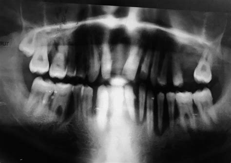 Peripheral Giant Cell Granuloma Radiograph