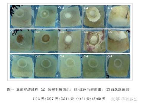 真菌感染的灰指甲（脚趾甲），拔甲后大概多少天能正常运动？ - 知乎