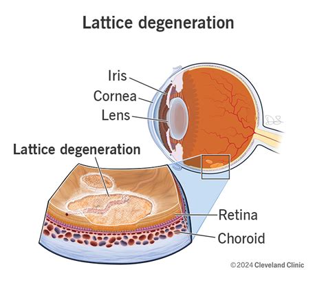 Lattice Degeneration: Symptoms, Causes & Treatment