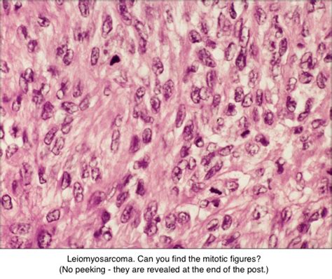 Leiomyoma vs. leiomyosarcoma | Pathology Student