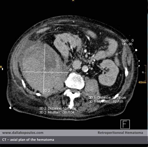 Retroperitoneal Hematoma - Figure 6 | CT – sagittal plan of … | Flickr