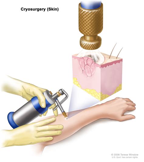 Skin Cancer Treatment - NCI