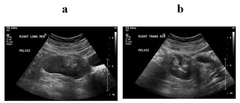 Right pelvic kidney on Renal Ultrasound. a) Longitudinal View, b ...