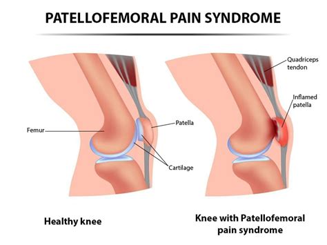 Patellofemoral Pain Syndrome (PFPS) Treatment NJ & NYC | Patellofemoral ...