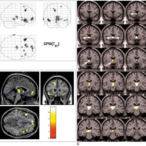 Brain regions showing reduced gray matter concentrations in patients... | Download Scientific ...