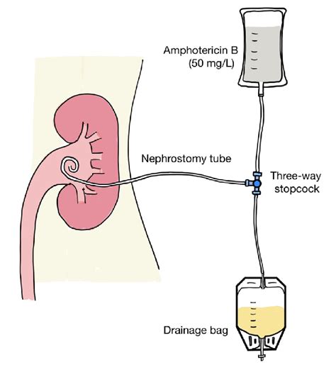 İllustration of the connection of the nephrostomy tube, drainage bag... | Download Scientific ...