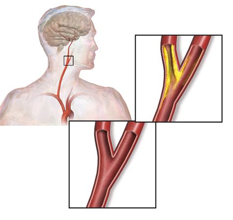 Carotid Artery Stenosis | Concise Medical Knowledge