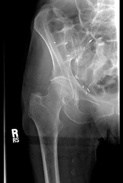 Occult fracture - wikidoc