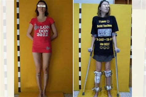 Aspiring Model Gets Leg Surgery to Increase Her Height to Industry ...