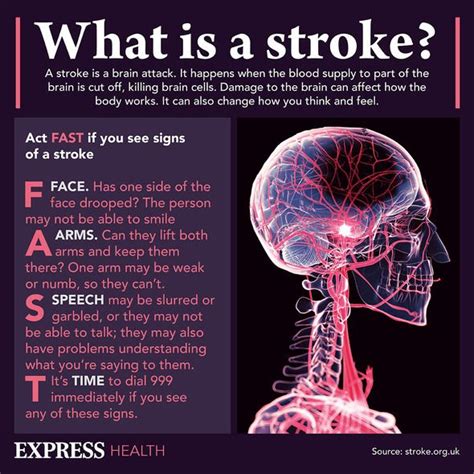 Stroke symptoms: Eight 'subtle' signs of a brain attack – call 999 now ...