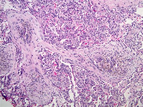 Jerad Gardner, MD on Twitter: "RT @smlungpathguy: If you need a chest CT to figure out what this ...