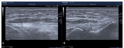 Ultrasound images of the bilateral common extensor tendon (CET) on ...