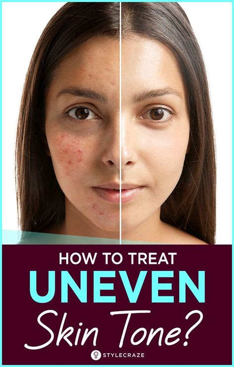 Uneven Skin Tone? Tips To Get Rid Of It Naturally #skin #care #skincare #beauty Face Skin Care ...