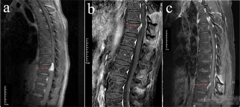 Images of spinal cord tumor (axial). (a) Before surgery, MRI revealed... | Download Scientific ...