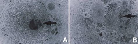 Figure 1 from Pulmonary Alveolar Proteinosis | Semantic Scholar