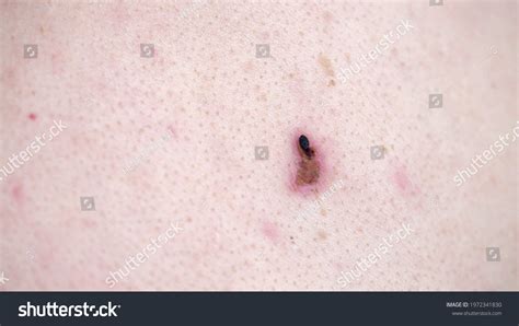 Removal Papilloma On Human Skin Cauterization Stock Photo 1972341830 | Shutterstock