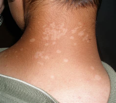 Tinea Versicolor- A Cause of Circular Patches on the Trunk and Face