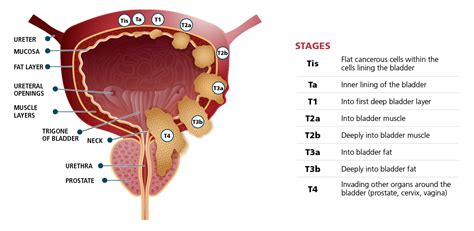 Bladder Cancer & Treatment – The Robotic Surgeon – Domenico Savatta, M.D.