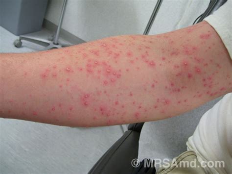 MRSA Pictures / Staph Infection Pictures/Graphic Images – MRSA MD