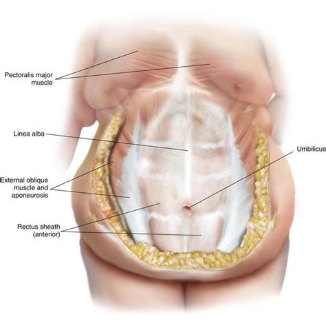 Panniculectomy and Abdominal Wall Reconstruction | Clinical Gate