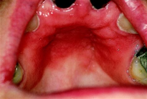 Medical Pictures Info – Angular Stomatitis