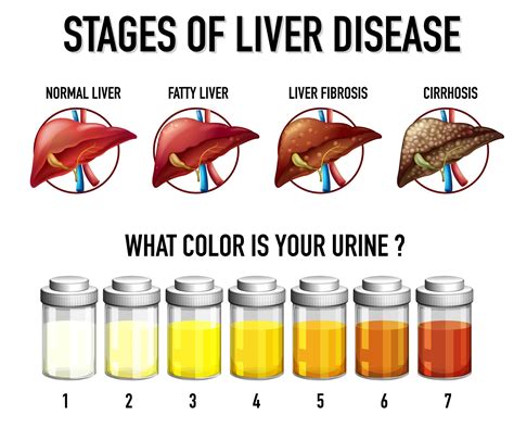 Stages of liver disease 1868462 Vector Art at Vecteezy