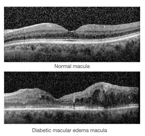 Diabetic Macular Edema