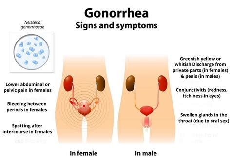 gonorrhea,what to know?